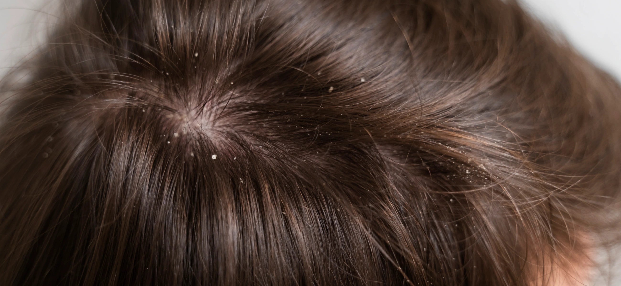 Can dandruff really cause hair loss?