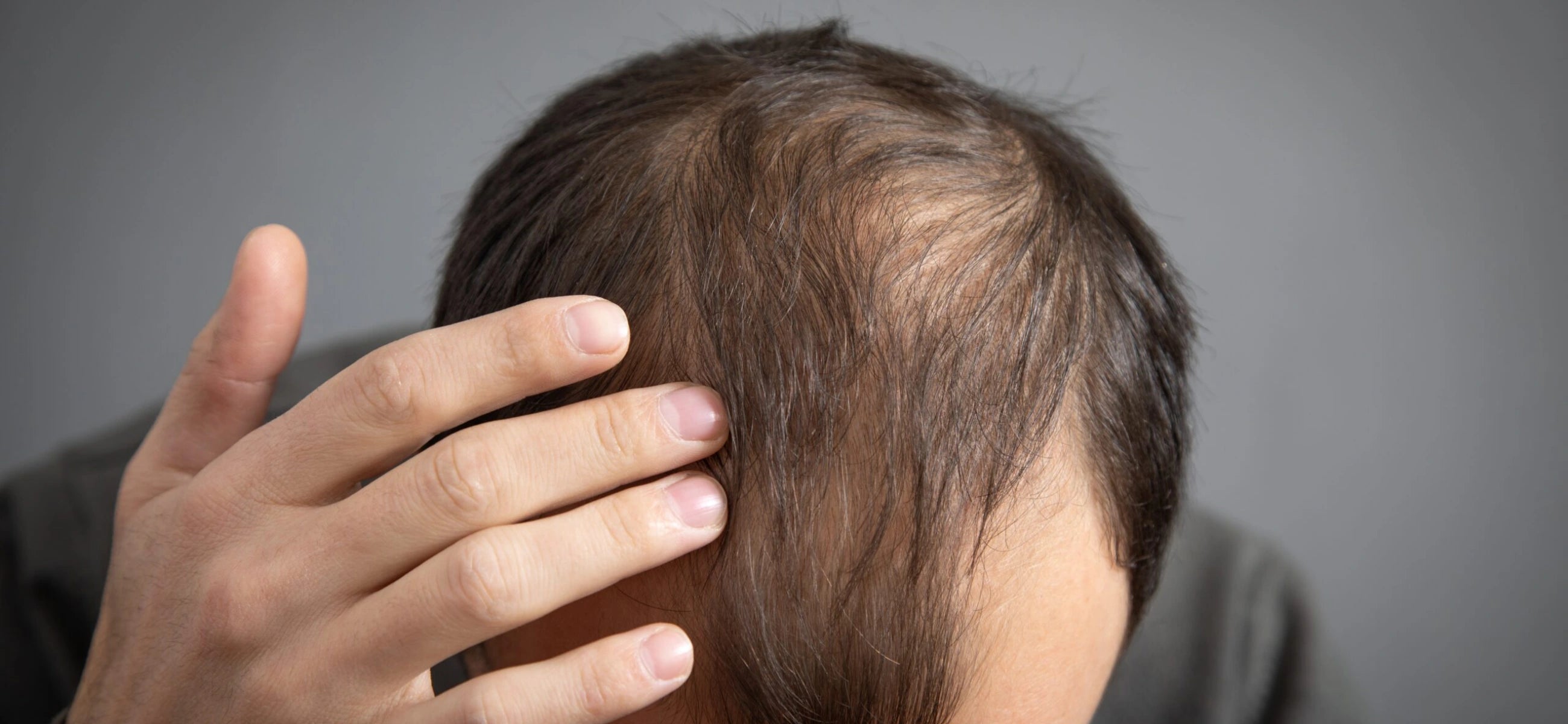 Does Mounjaro cause hair loss? Exploring the connection and what to know