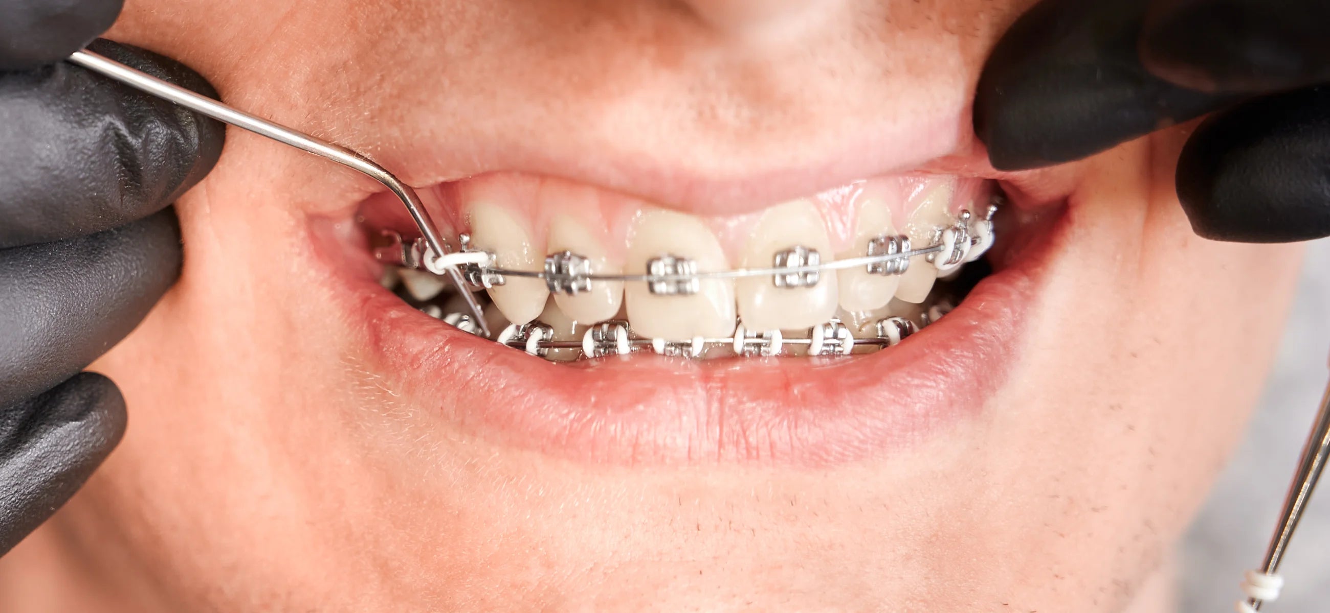 Brace yourself - how much do braces actually cost?