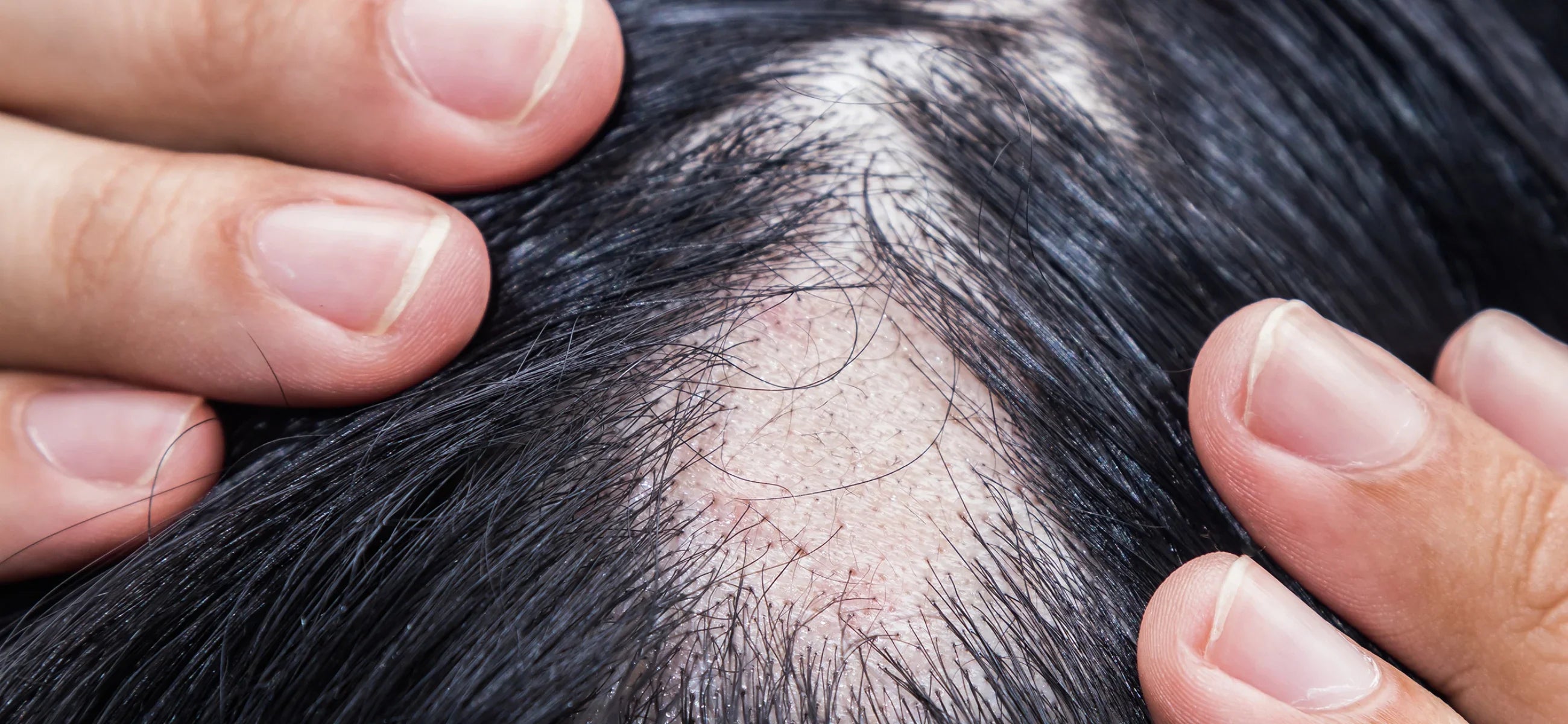 What causes hair loss?